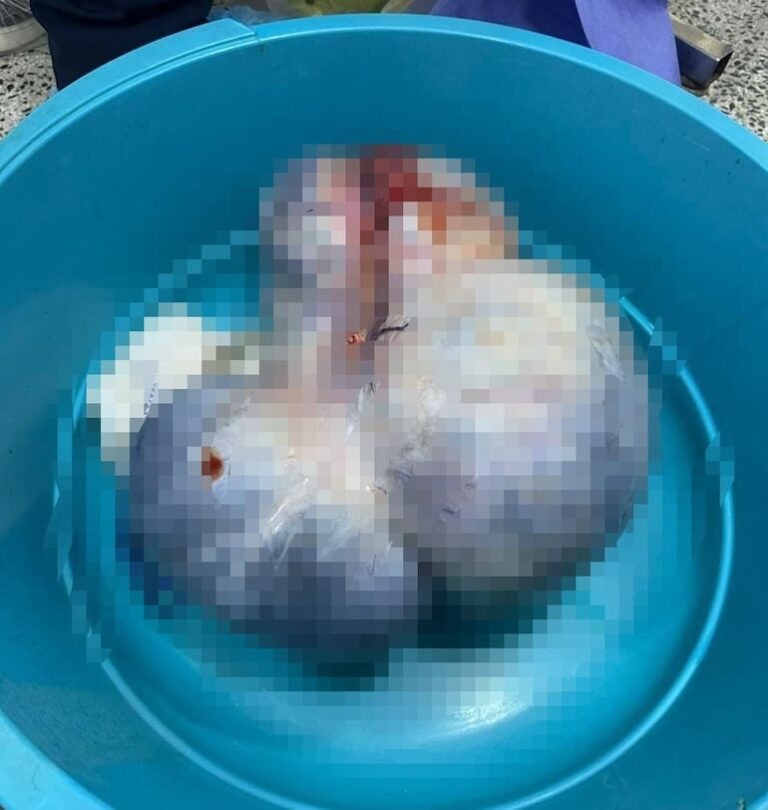 Extraen enorme tumor de ovario en Hospital de Pedro Juan Caballero.