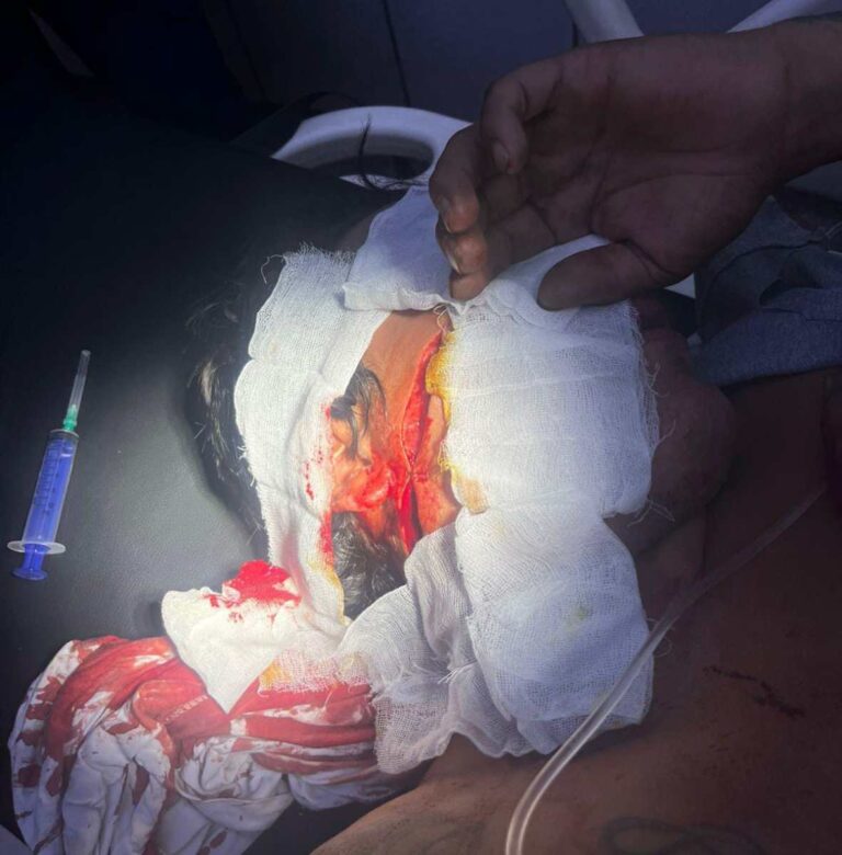 Hombre con antecedentes resulta herido en el rostro con machete.